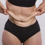 Key Factors to Consider for Avoiding Loose Skin During Weight Loss