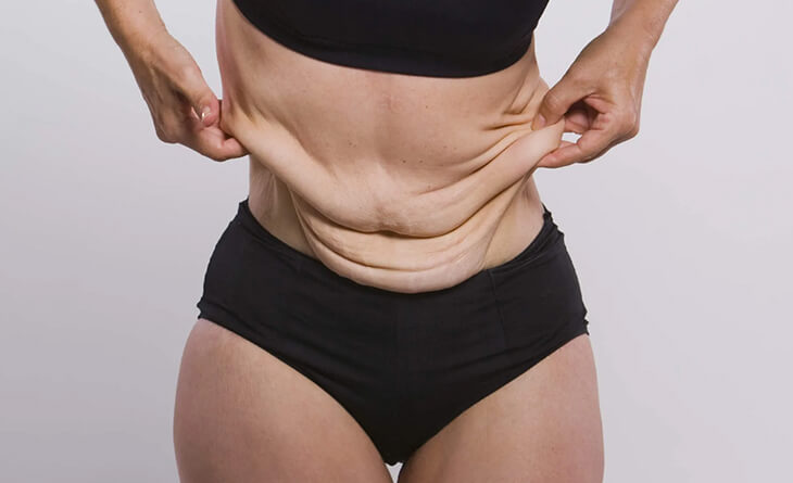 Key Factors to Consider for Avoiding Loose Skin During Weight Loss